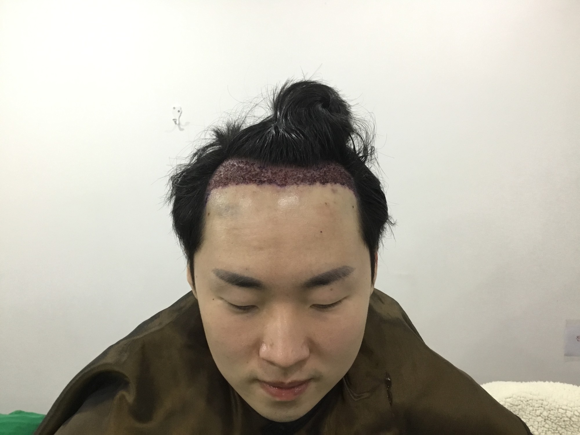 수술 직후