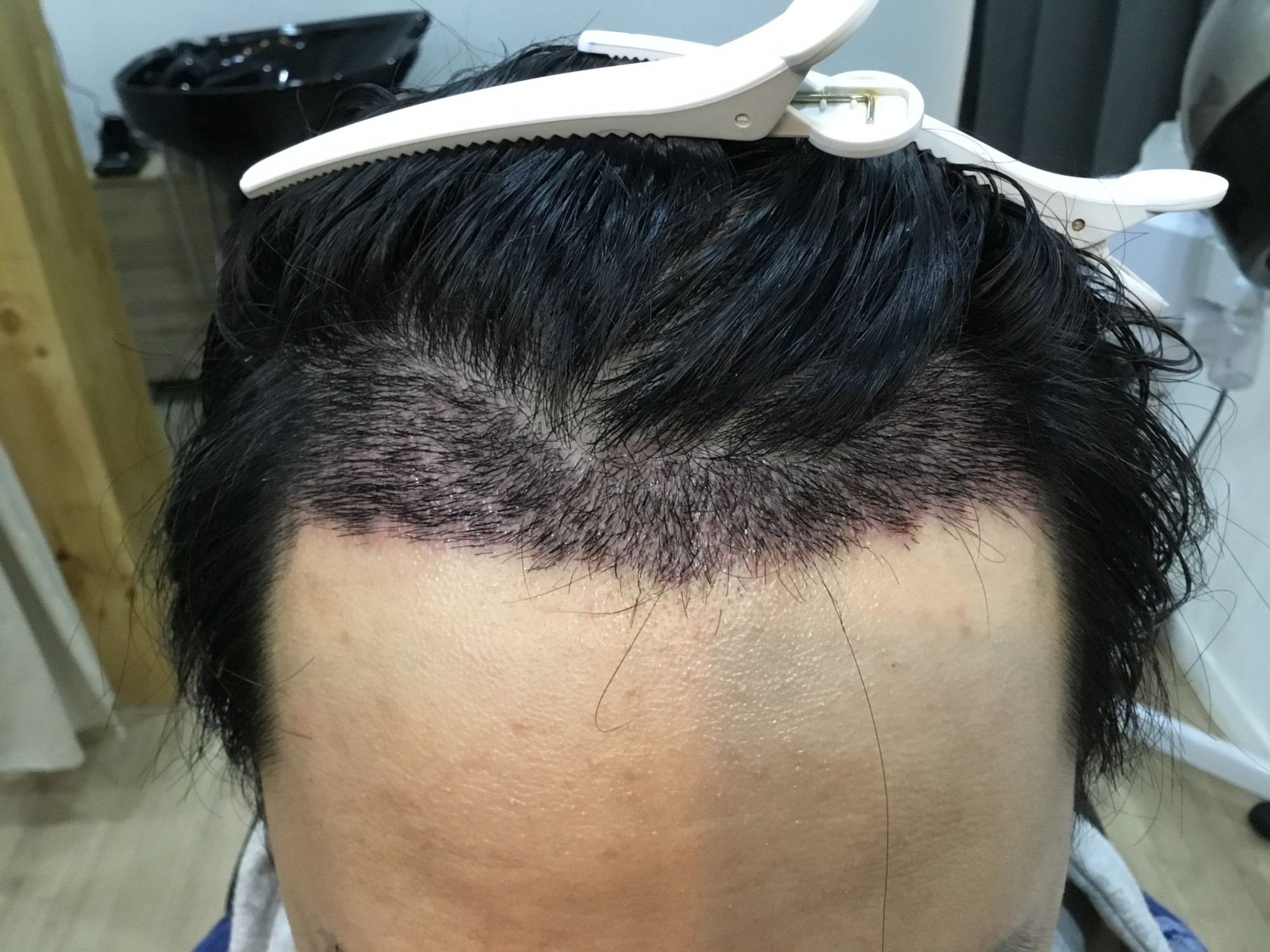 이식 직후 헤어라인