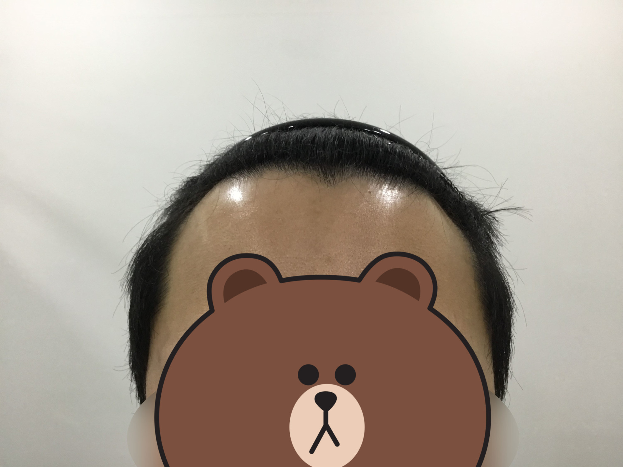 수술 전