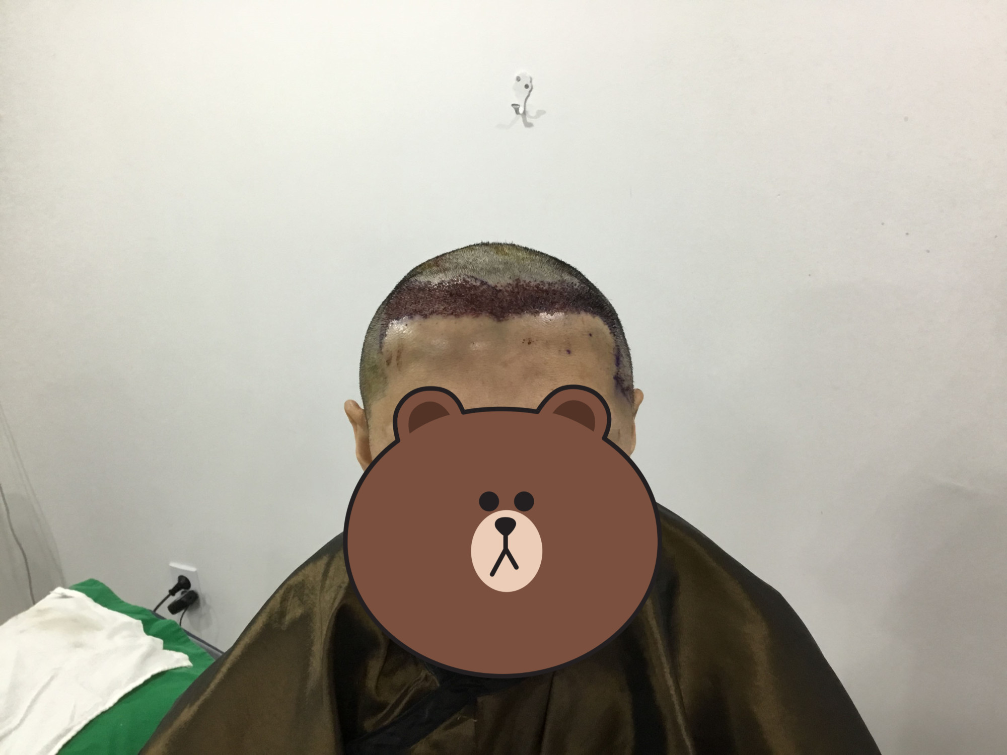 수술 직후