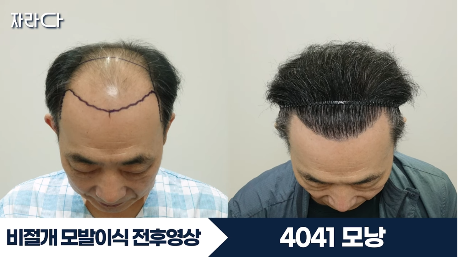 수술 전후