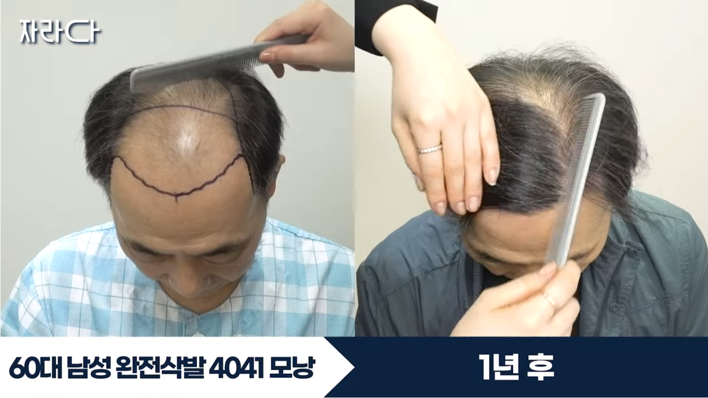 수술 전후