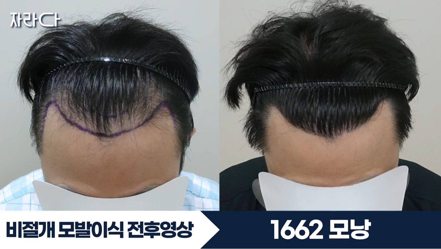 수술 전후