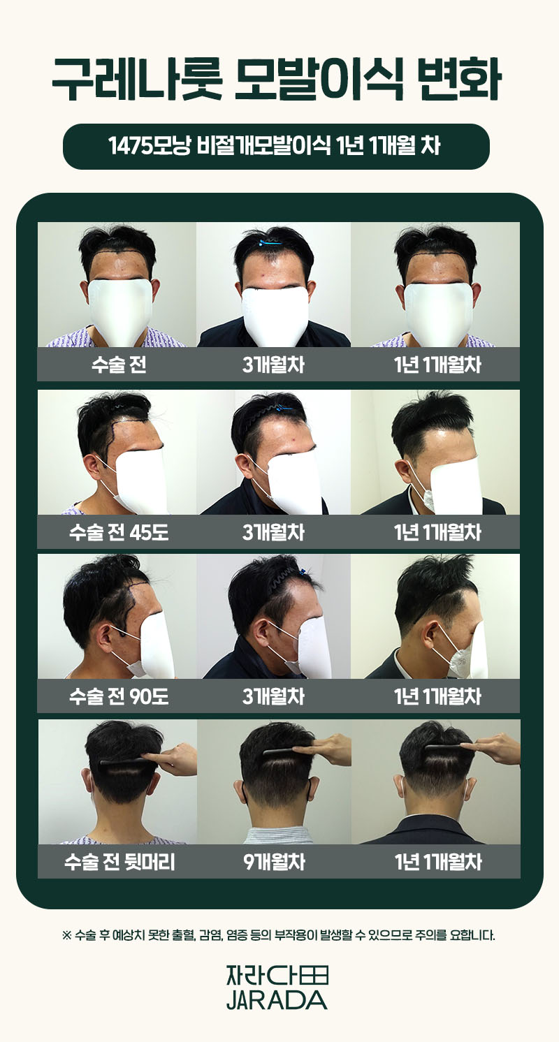헤어라인과 구레나룻 이식 경과