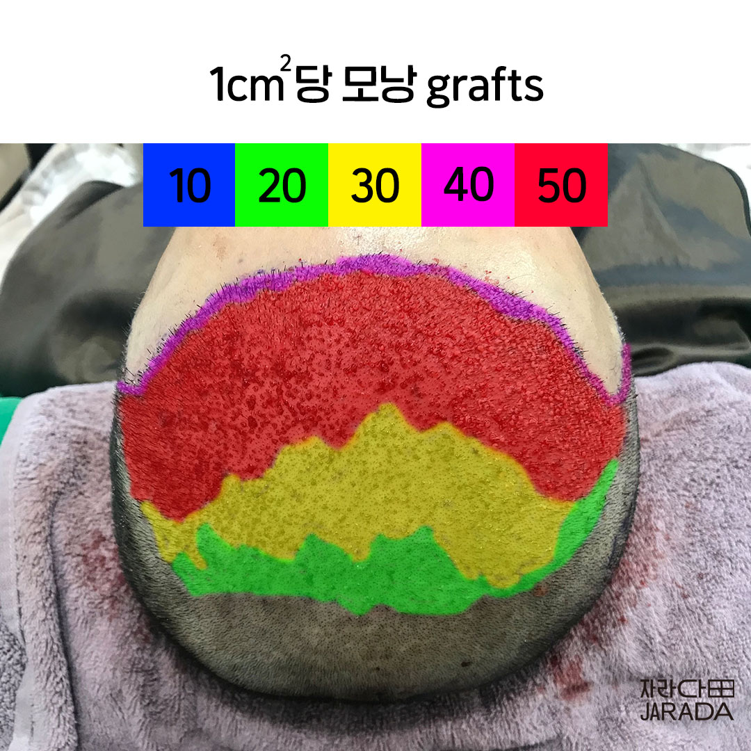 1제곱센티미터당 모낭 수 배분