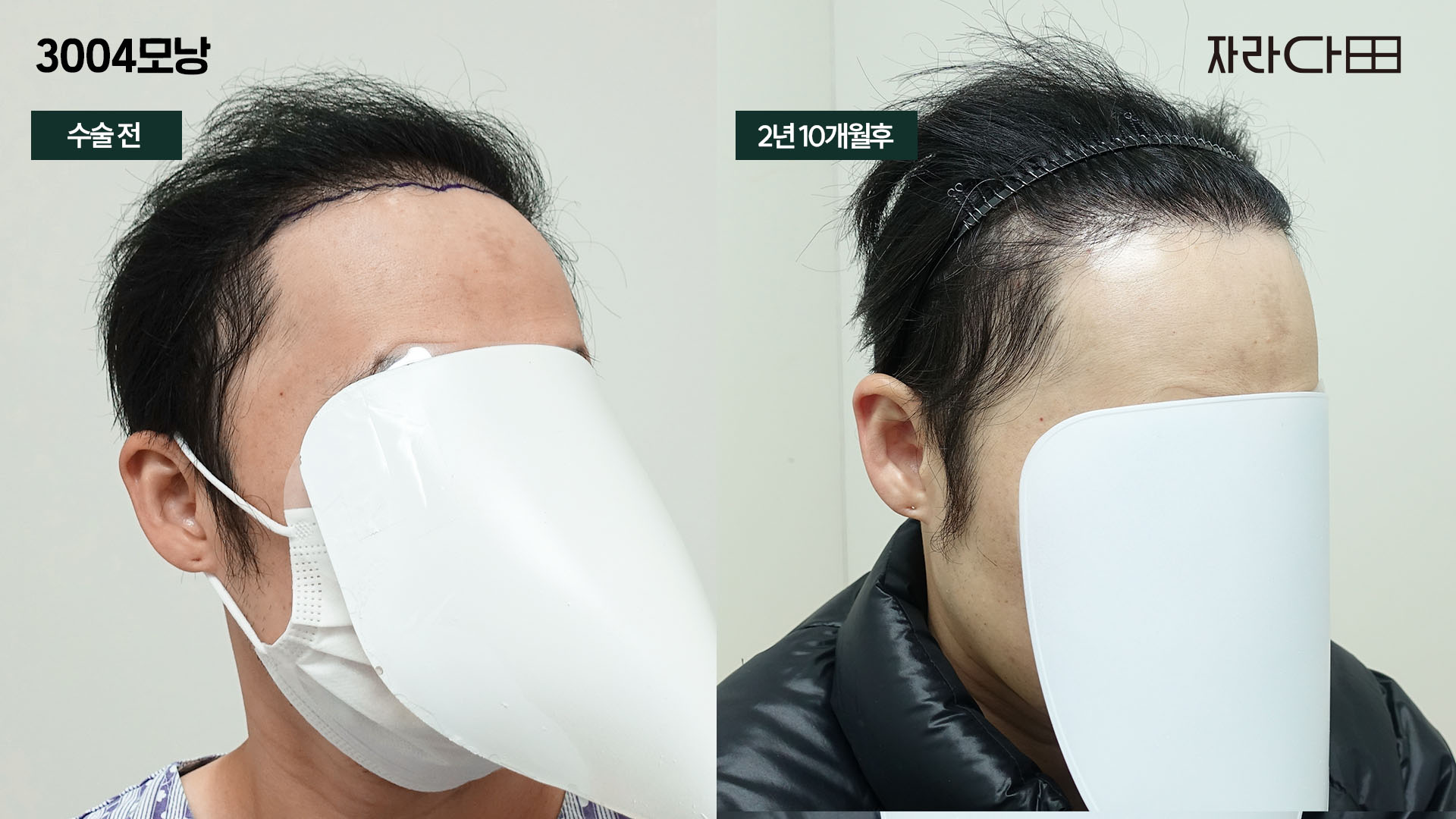 측면 각도