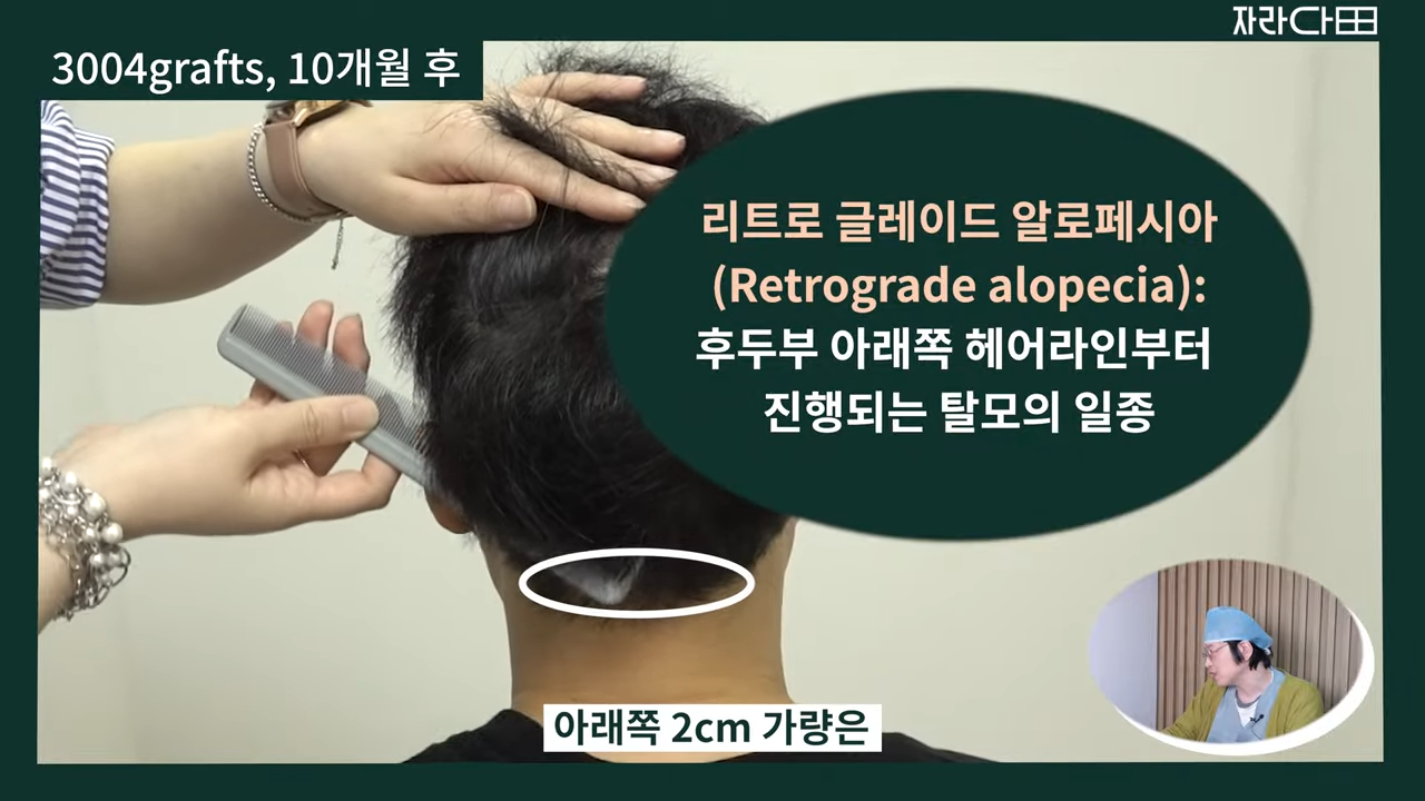 역행성 탈모증