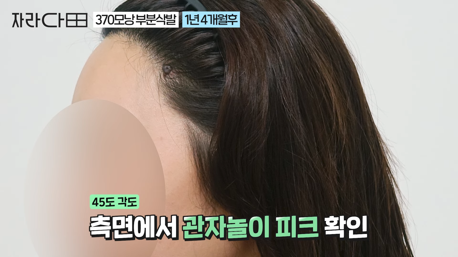 관자놀이 피크와 370모낭 사례