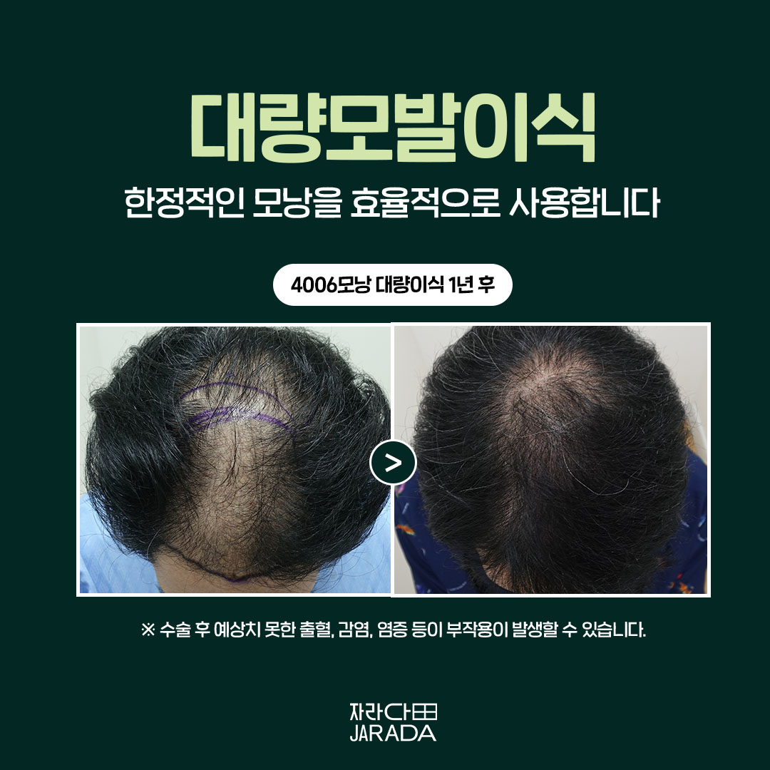 대량모발이식