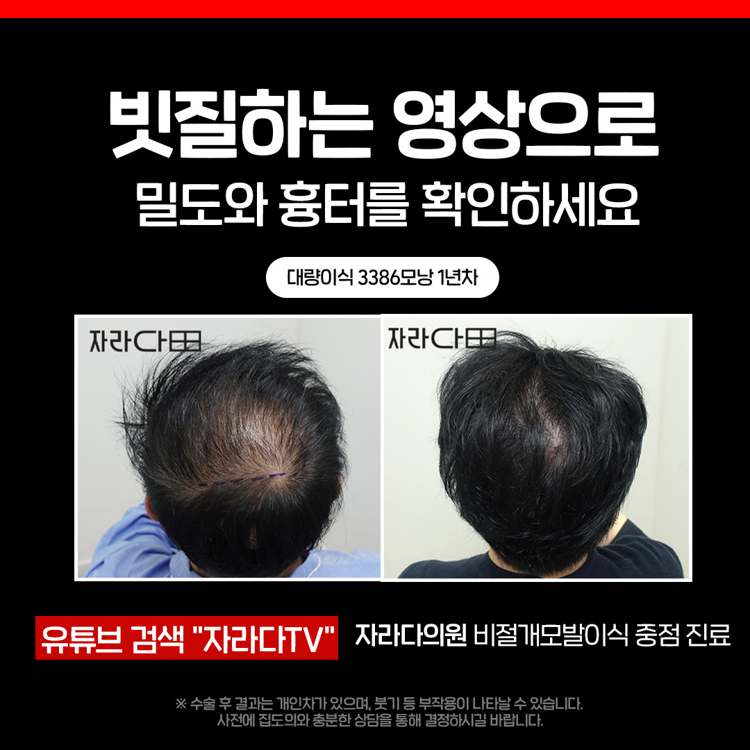 빗질로 밀도와 흉터 확인