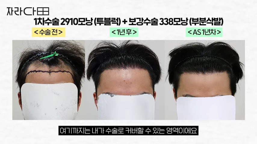 1차 수술과 보강 수술 경과