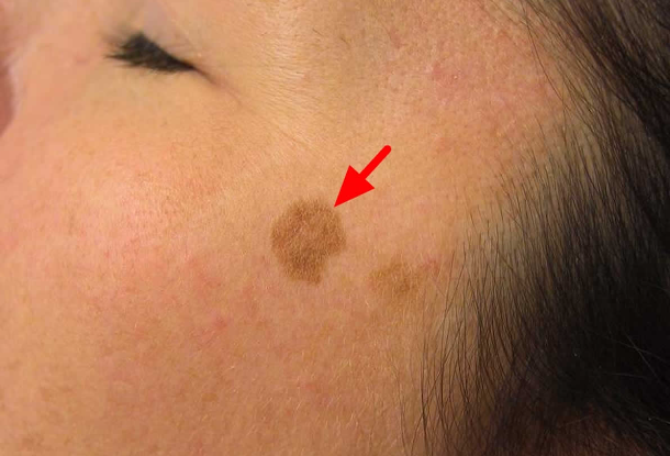 Lentigo: Laser Treatment and Prevention