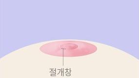 유두부에 작은 절개창을 냅니다.