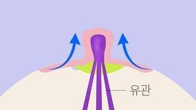 유관이나 유두혈관에 손상없이 유관을 늘려줍니다.