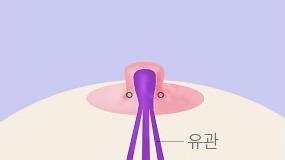 늘여준 유관조직의 돌출을 보강해주는 쌈지봉합법으로 봉합해줍니다.