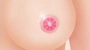 유두쪽으로 주변피부를 봉합