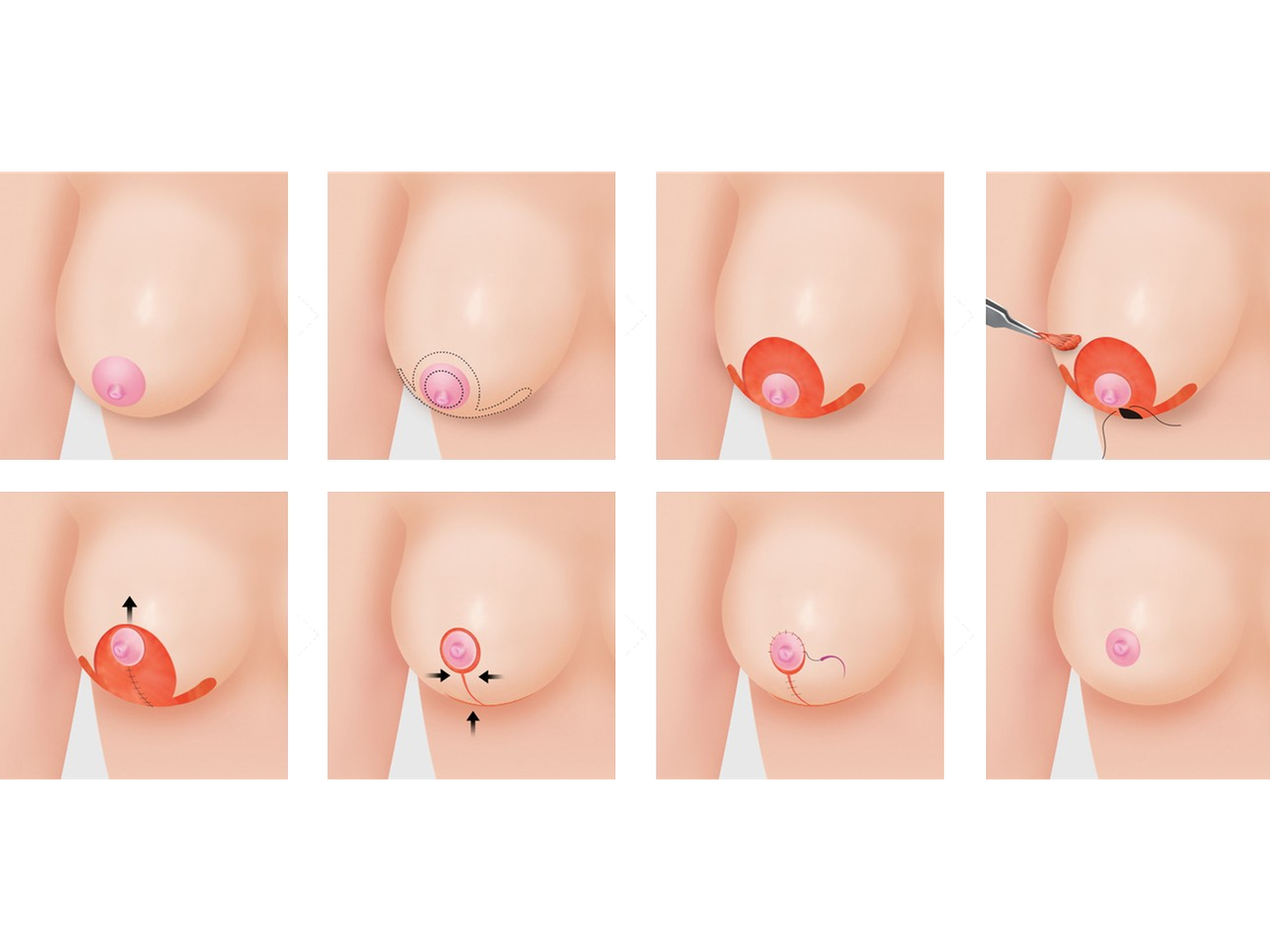 오자 절개법(오메가 절개법)