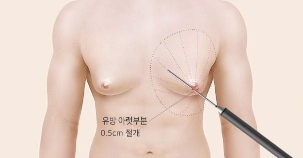 지방조직 흡입