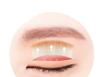 절개 눈매교정