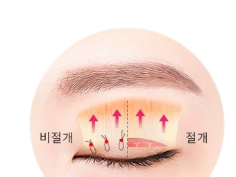 무쌍 눈매교정