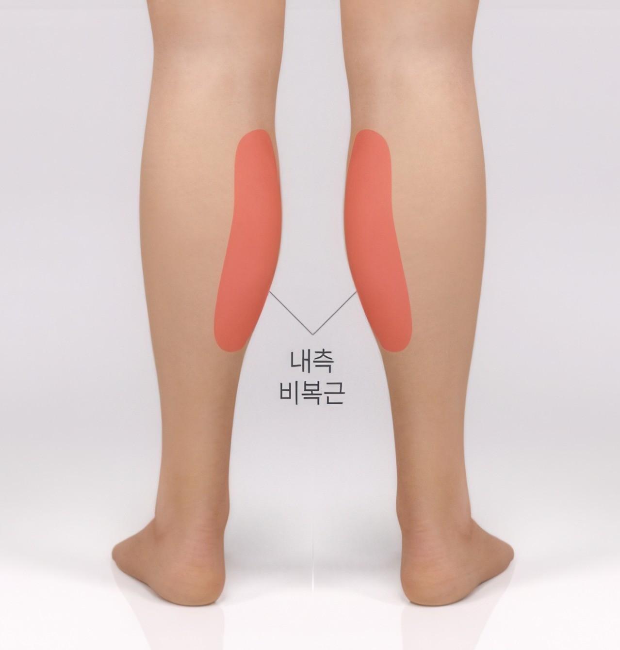 내측 발달형