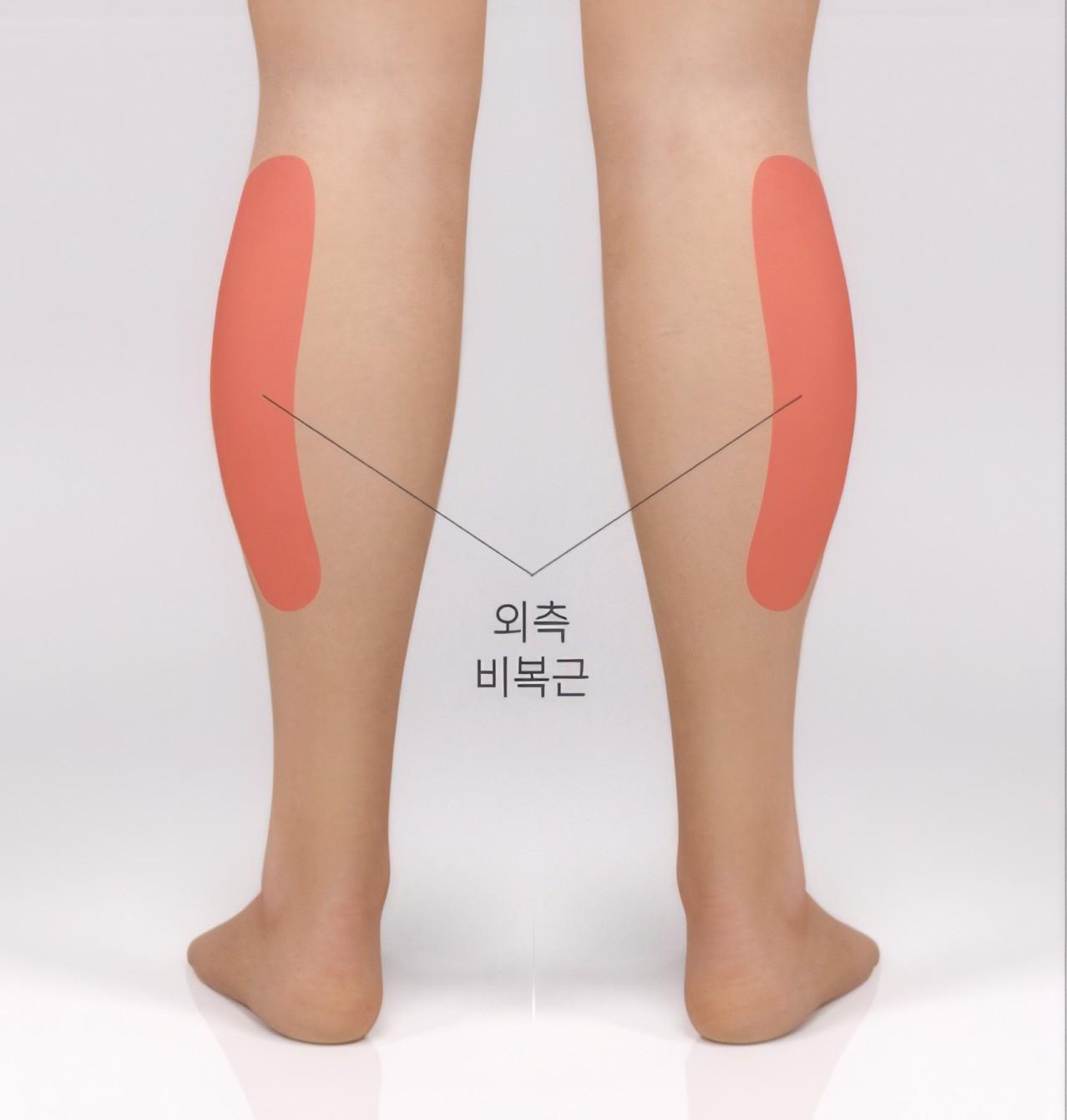외측 발달형