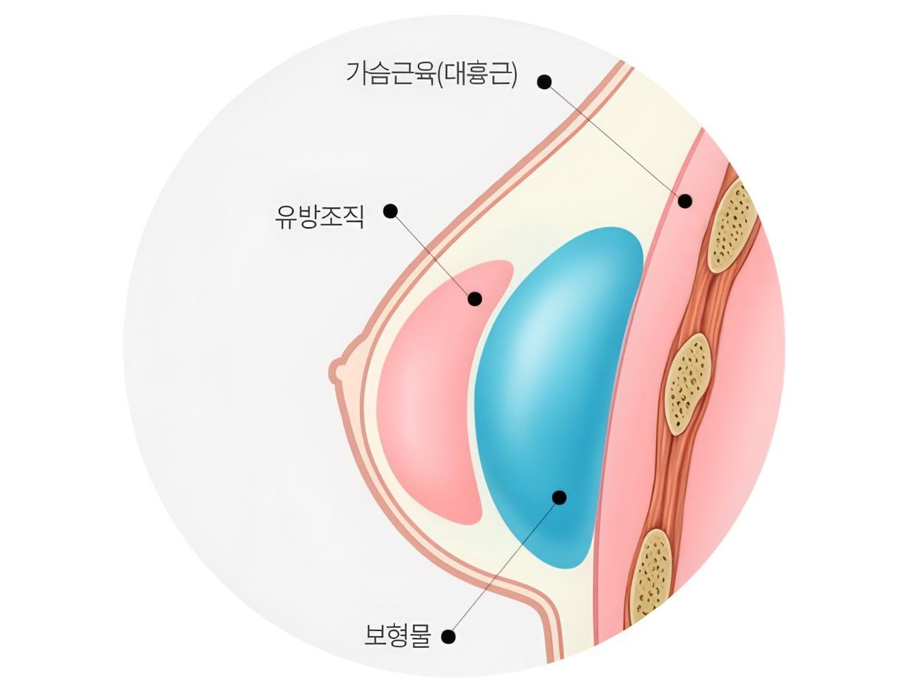 근육 위 삽입