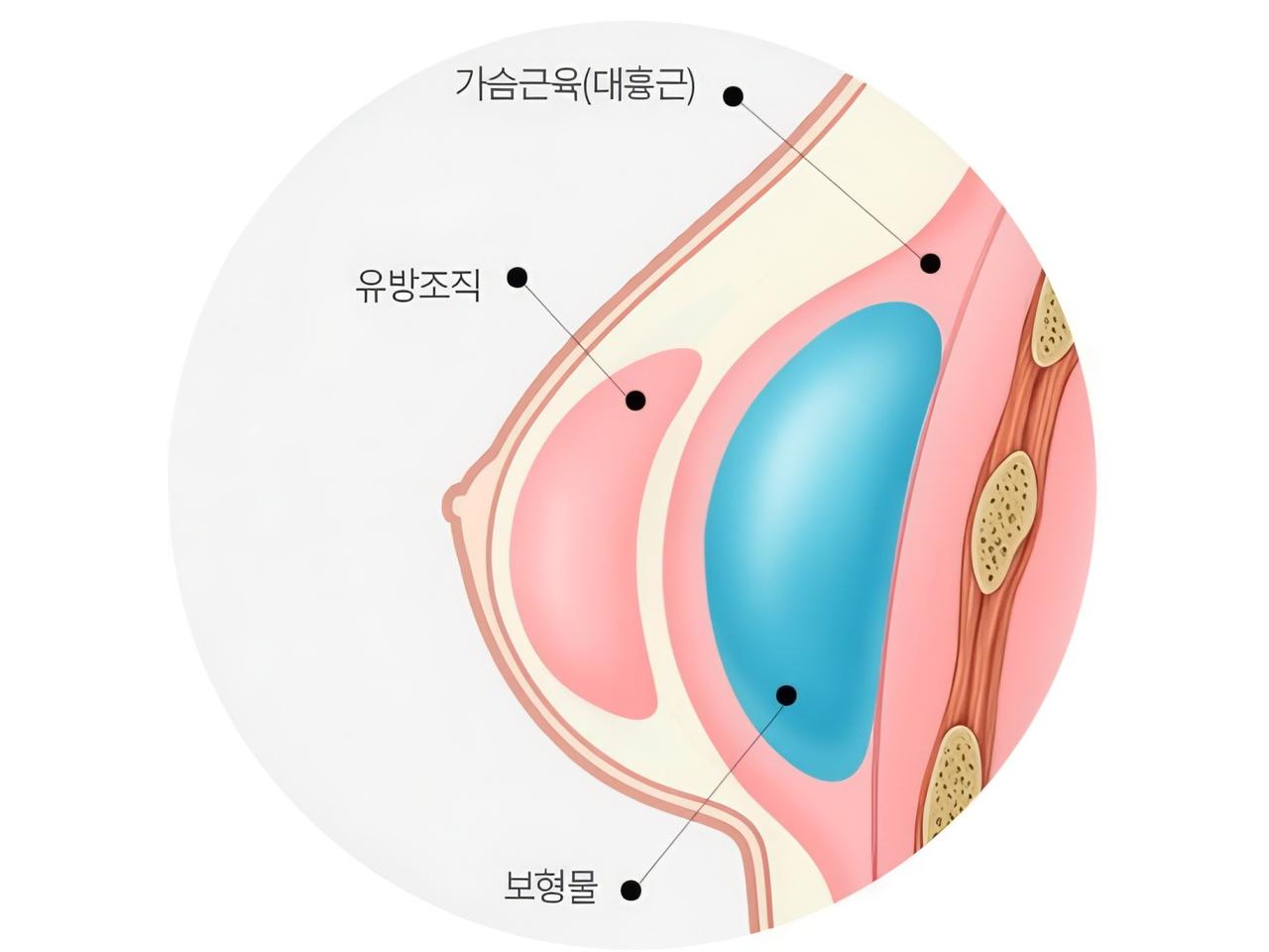 근육 아래 삽입