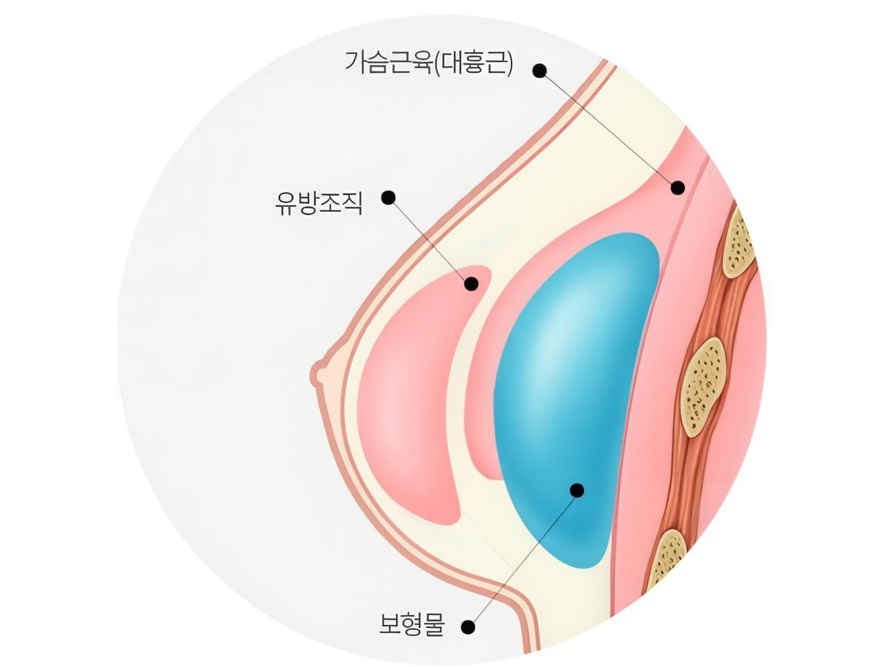 이중평면 삽입