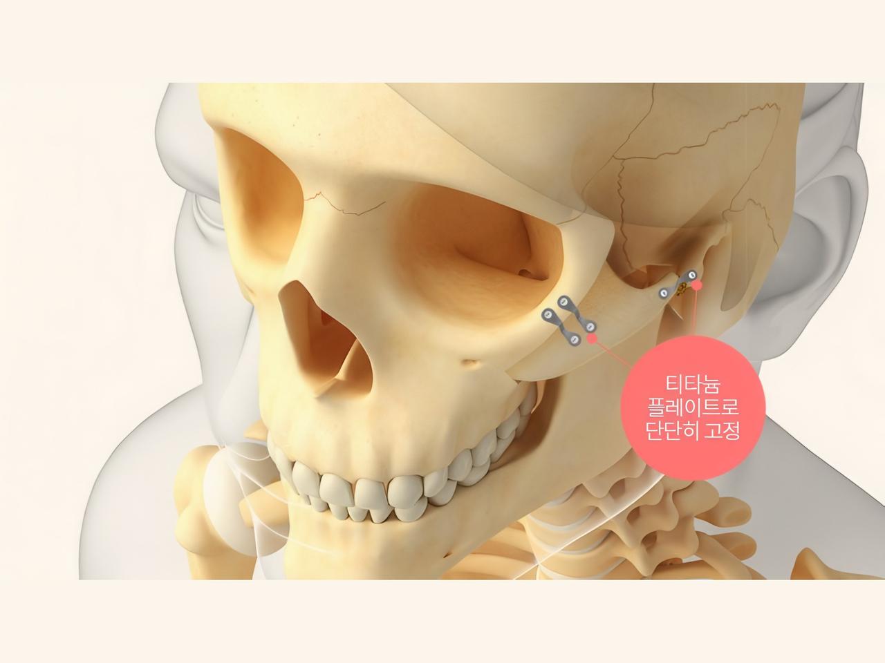 3D zygoma reduction