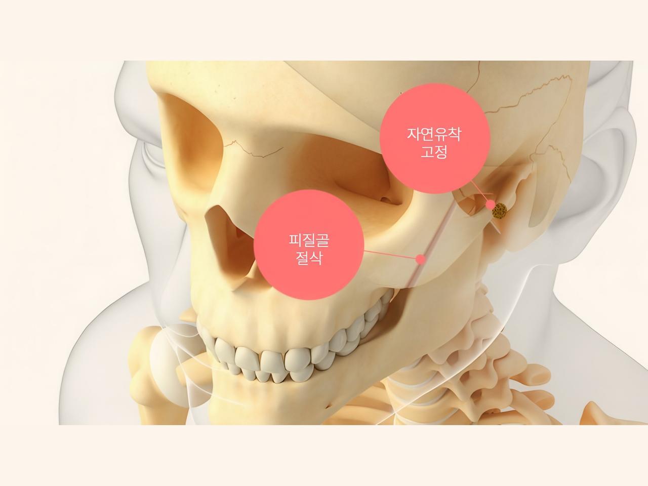 Quick zygoma reduction (non-fixation)