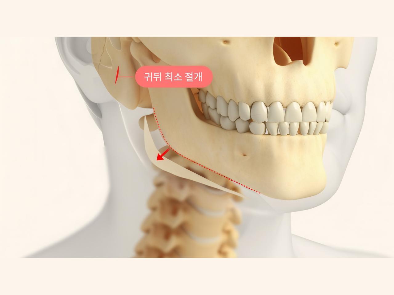 Behind-the-ear angle reduction