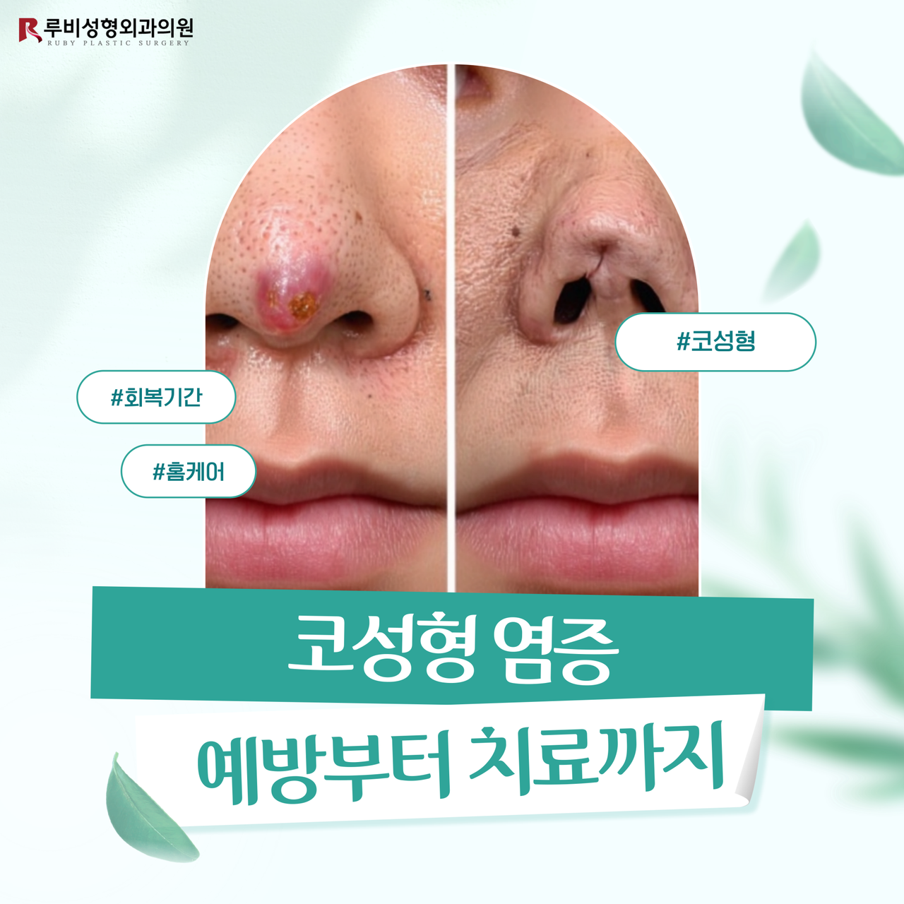 신사역 성형외과 코성형 염증, 원인과 증상부터 예방과 치료까지