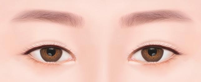쌍꺼풀이 풀린 경우