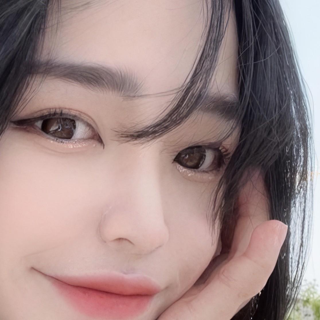 심한 안검하수도 교정