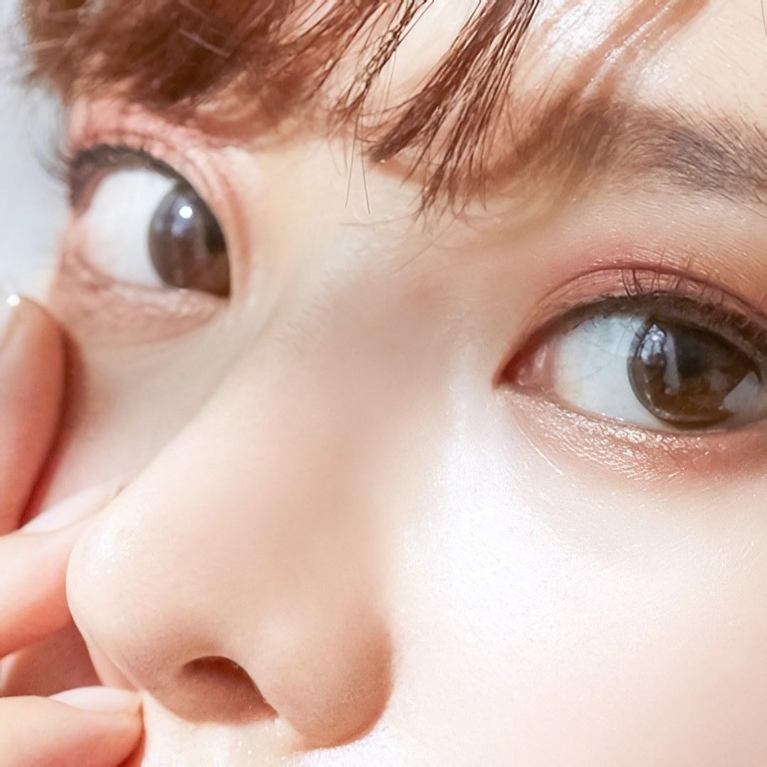 눈꺼풀 조직 제거로 또렷한 눈매