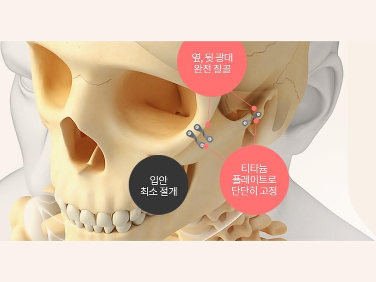 3D 광대 축소술
