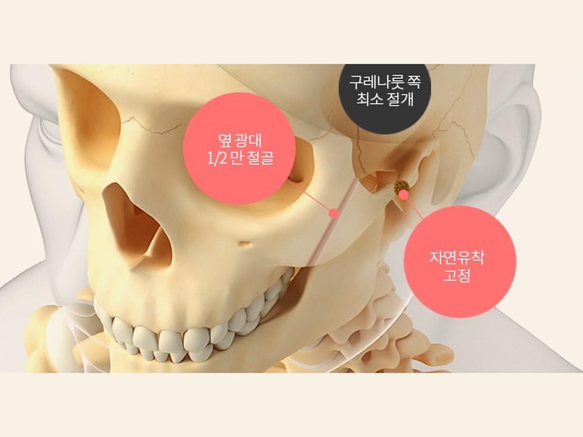 퀵 광대 축소술