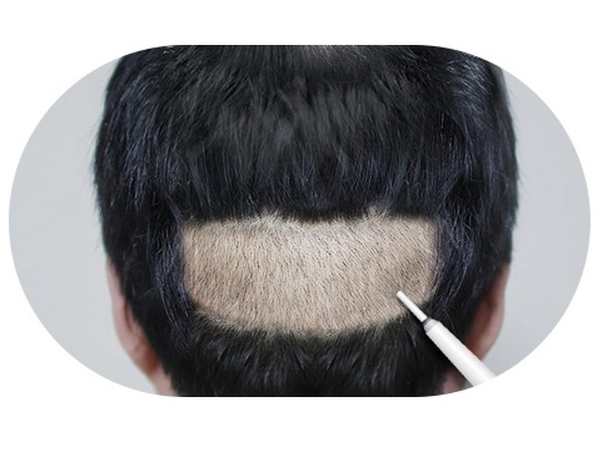 비절개 모발이식