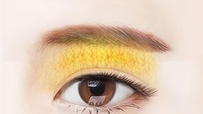 눈꺼풀 지방 분석