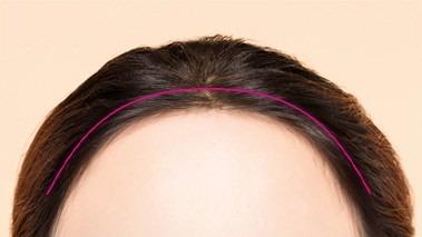 Hairline incision