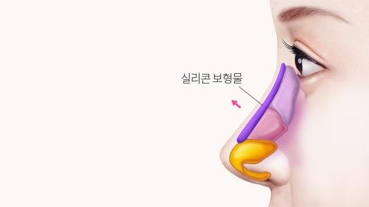 콧대 실리콘 삽입