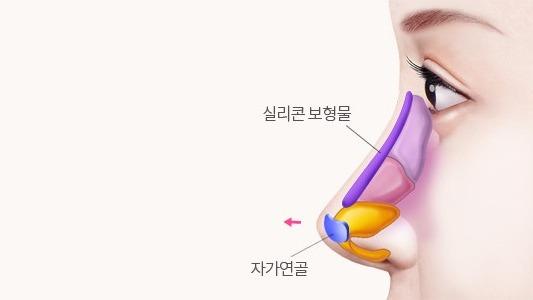 콧대 자가조직 삽입