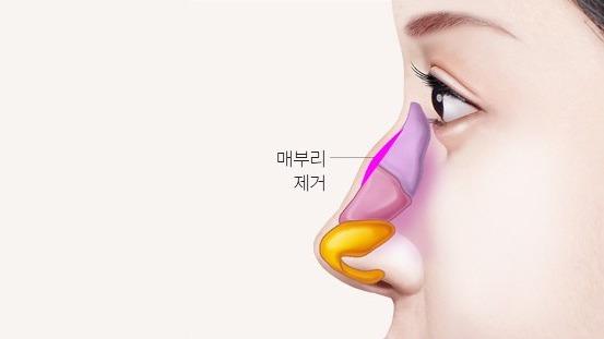 매부리 제거