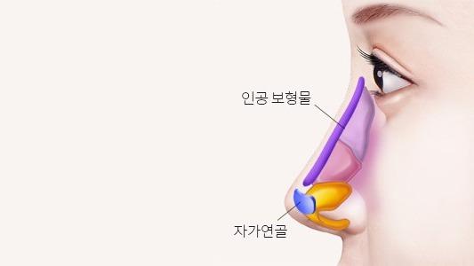 보형물로 콧대를 보충