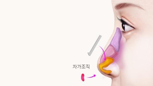 자가조직 삽입