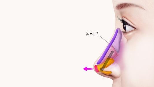 콧대, 코끝, 콧날개 교정