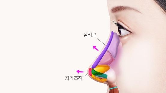 콧대, 코끝 추가 삽입
