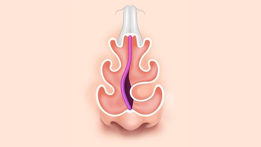 C형 비중격 만곡증