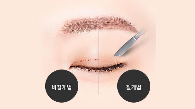 미세 구멍 만들기 | 눈꺼풀 절개
